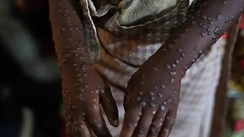 Viruela del mono: Más de 40 mil casos de mpox en África en 2024