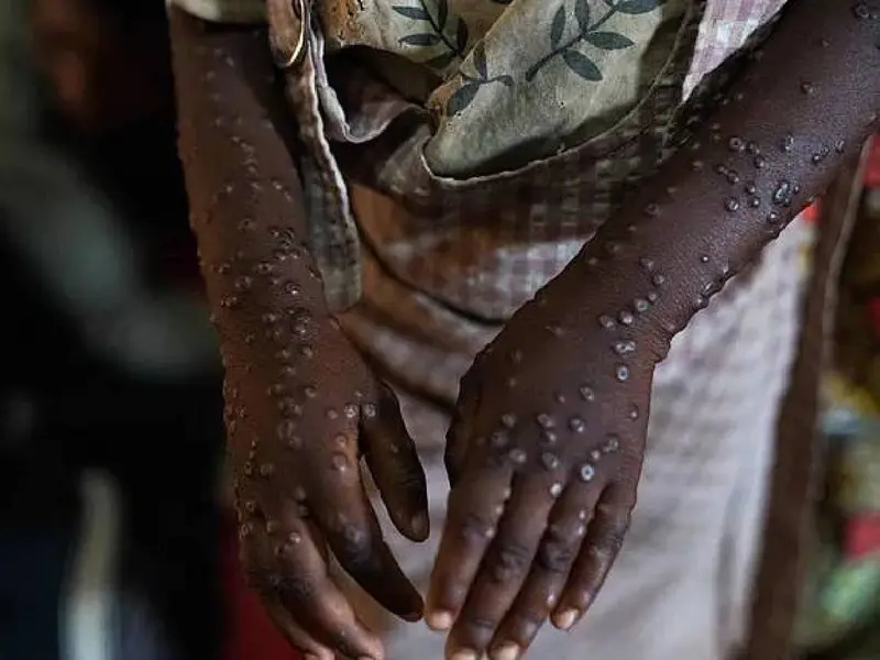 Viruela del mono: Más de 40 mil casos de mpox en África en 2024